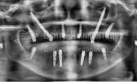 Восстановление зубов на двух челюстях  - Фотография 4